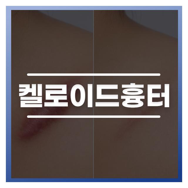 켈러이드흉터, 치료부터 관리까지 단단했더 조직이 부드러워지는 변화